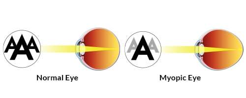 Myopia Control